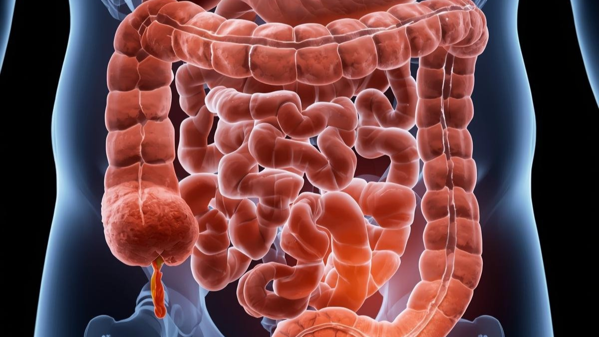 Colorectal cancer