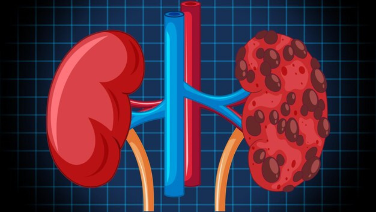 Polycystic kidney disease
